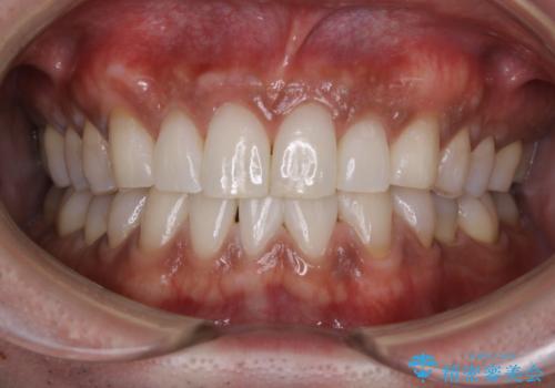 PMTCで歯周病の予防の治療後