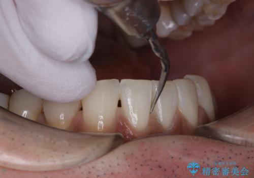 PMTCで歯周病の予防