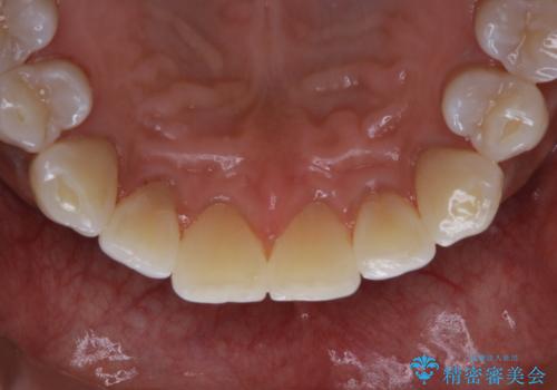 PMTCで歯周病の予防の治療後