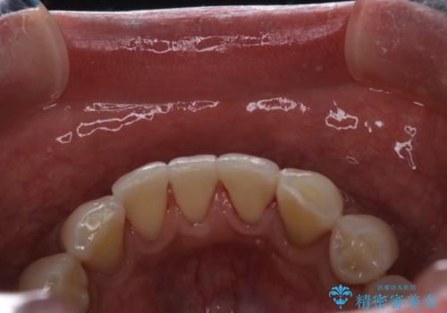 PMTCで歯周病の予防の治療後