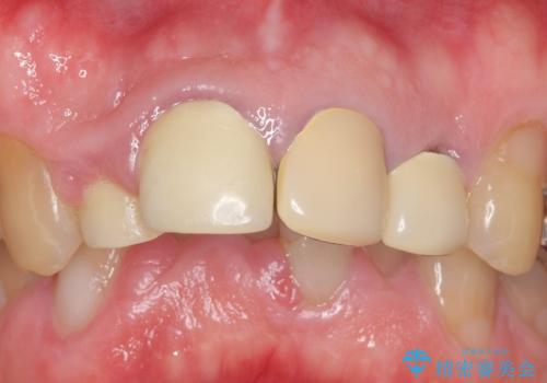 オールセラミッククラウン セラミックで前歯の見た目を改善の治療前