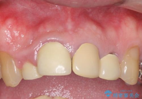 オールセラミッククラウン セラミックで前歯の見た目を改善の症例 治療前
