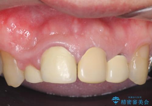オールセラミッククラウン セラミックで前歯の見た目を改善の治療前