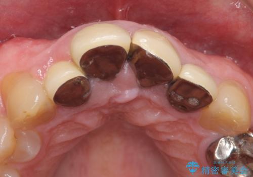 オールセラミッククラウン セラミックで前歯の見た目を改善の治療前
