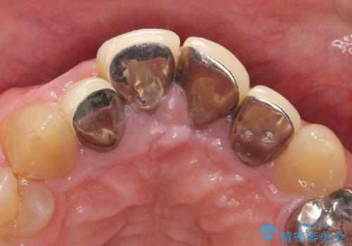 オールセラミッククラウン セラミックで前歯の見た目を改善の治療前