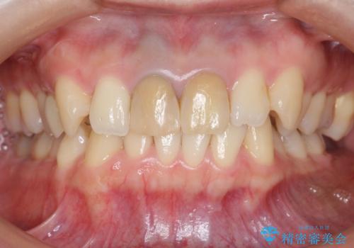 神経をとった前歯が変色してきたの治療前