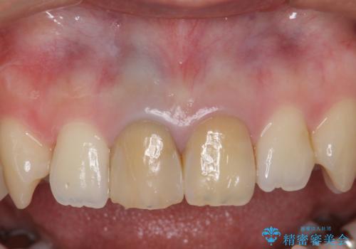 神経をとった前歯が変色してきた