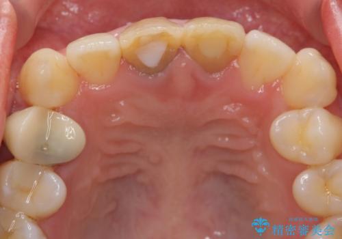 神経をとった前歯が変色してきたの治療前