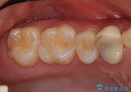 他院の根の治療で一向に治らない、さらに歯根を切ってもらったが良くならないの治療前