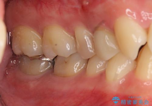 他院の根の治療で一向に治らない、さらに歯根を切ってもらったが良くならないの治療前