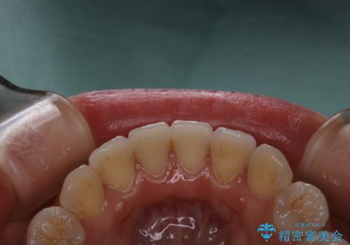 invisalignでの矯正治療が終了した方のPMTCの治療前