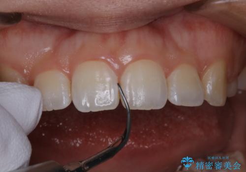 invisalignでの矯正治療が終了した方のPMTCの治療中
