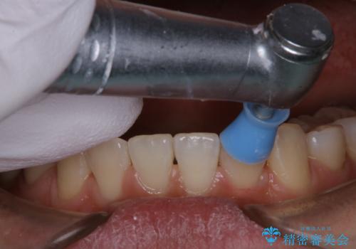 invisalignでの矯正治療が終了した方のPMTCの治療中