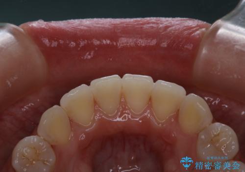 invisalignでの矯正治療が終了した方のPMTCの治療後