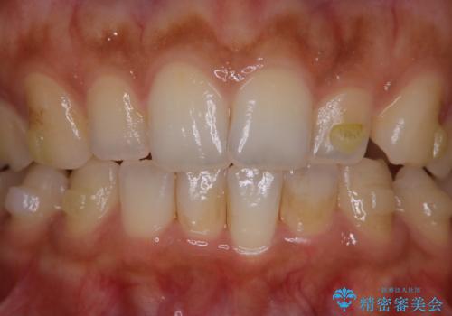 マウスピース矯正(invisalign)中のクリーニングの治療前