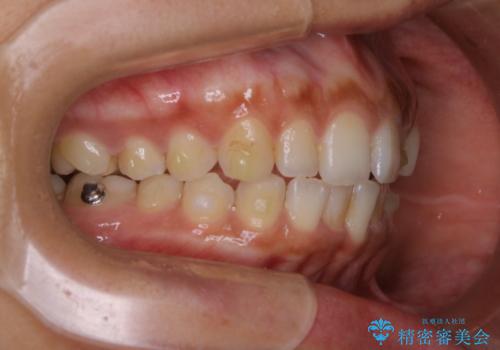 マウスピース矯正(invisalign)中のクリーニングの治療前