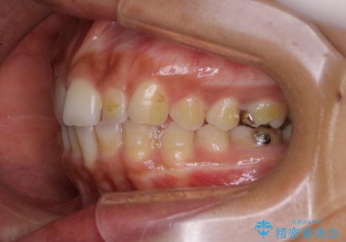 マウスピース矯正(invisalign)中のクリーニングの治療前