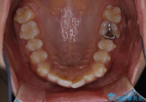 マウスピース矯正(invisalign)中のクリーニングの治療前