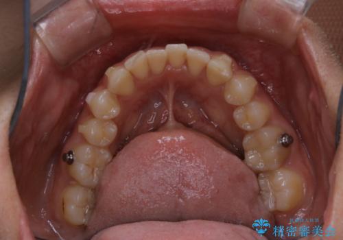 マウスピース矯正(invisalign)中のクリーニングの治療前