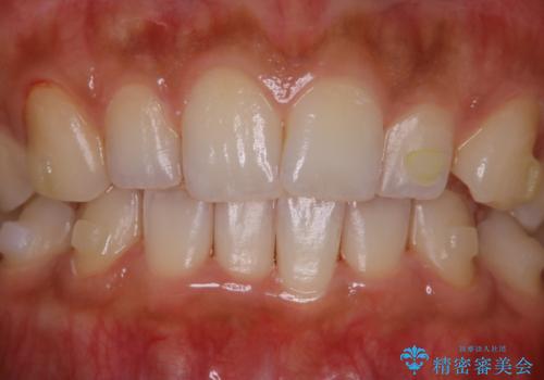 マウスピース矯正(invisalign)中のクリーニングの治療後