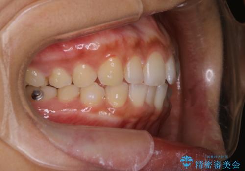 マウスピース矯正(invisalign)中のクリーニングの治療後