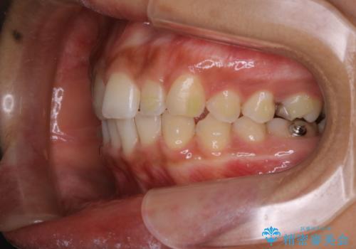 マウスピース矯正(invisalign)中のクリーニングの治療後