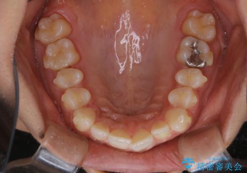 マウスピース矯正(invisalign)中のクリーニングの治療後