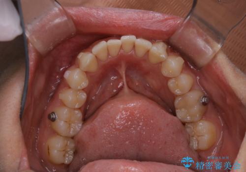 マウスピース矯正(invisalign)中のクリーニングの治療後