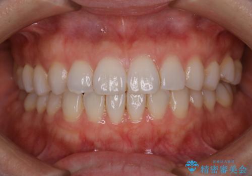 PMTCで見た目を綺麗にの症例 治療前