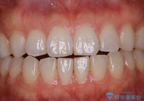 PMTCで見た目を綺麗にの治療前