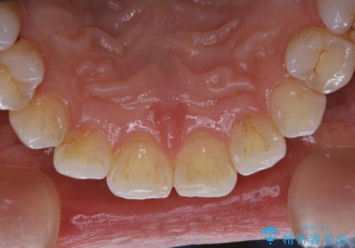 PMTCで見た目を綺麗にの治療前