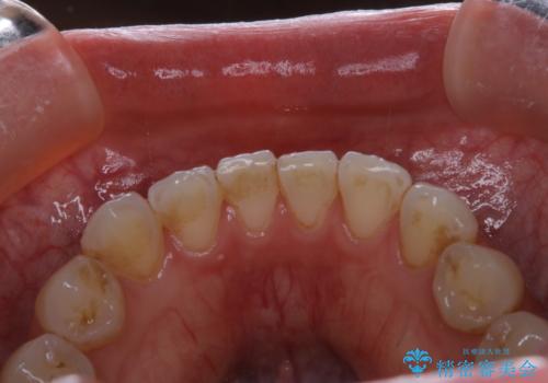 PMTCで見た目を綺麗にの治療前