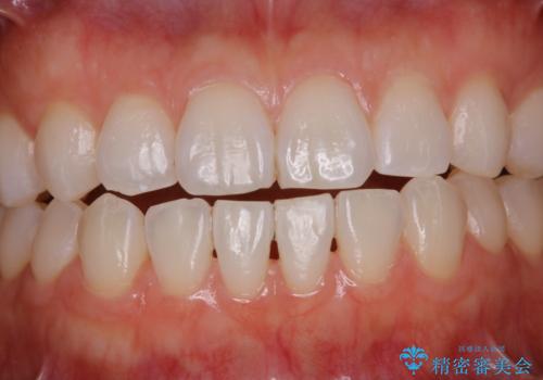 PMTCで見た目を綺麗にの治療後