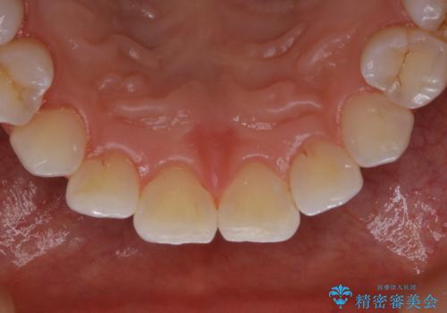 PMTCで見た目を綺麗にの治療後