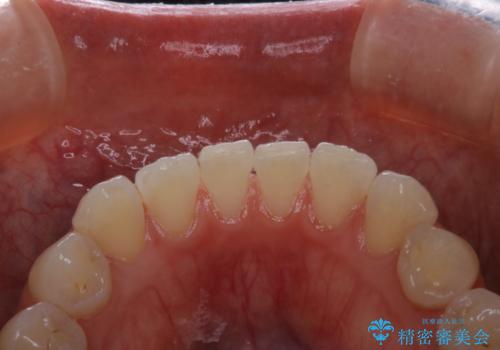 PMTCで見た目を綺麗にの治療後