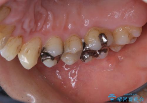 銀歯をセラミックに変える前にPMTCで現状の汚れをきれいに除去の症例 治療前