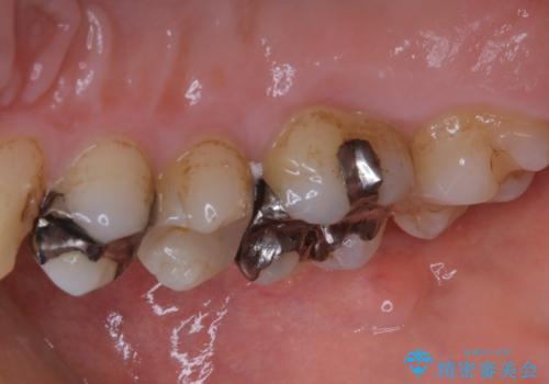 虫歯治療前のPMTCの症例 治療前
