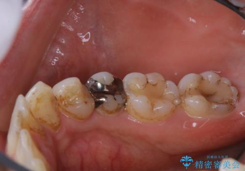 銀歯をセラミックに変える前にPMTCで現状の汚れをきれいに除去の治療前