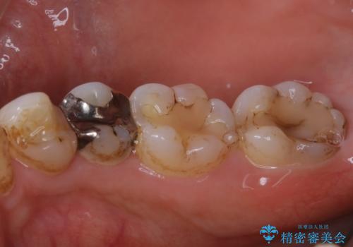 虫歯治療前のPMTCの治療前
