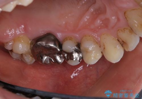 銀歯をセラミックに変える前にPMTCで現状の汚れをきれいに除去の治療前