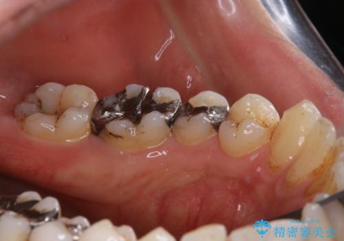 銀歯をセラミックに変える前にPMTCで現状の汚れをきれいに除去の治療前