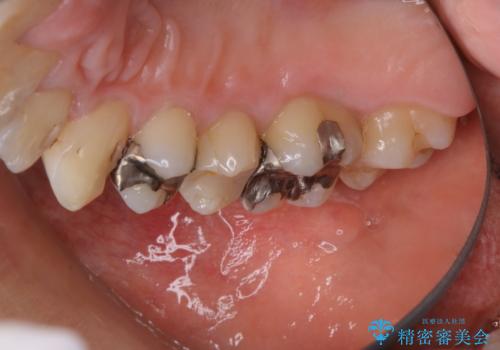 銀歯をセラミックに変える前にPMTCで現状の汚れをきれいに除去の症例 治療後