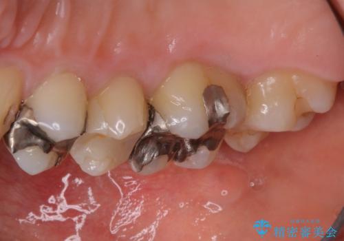 虫歯治療前のPMTCの症例 治療後