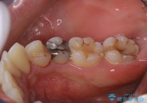 銀歯をセラミックに変える前にPMTCで現状の汚れをきれいに除去の治療後