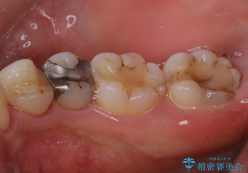 虫歯治療前のPMTCの治療後