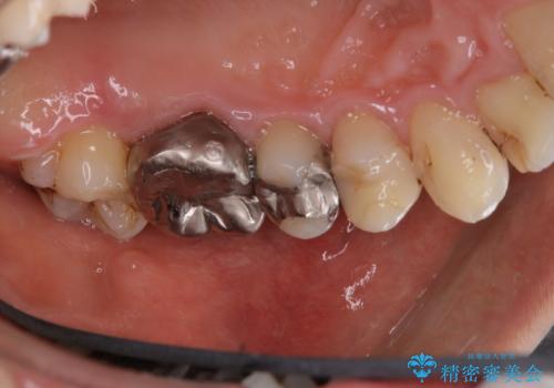 銀歯をセラミックに変える前にPMTCで現状の汚れをきれいに除去の治療後