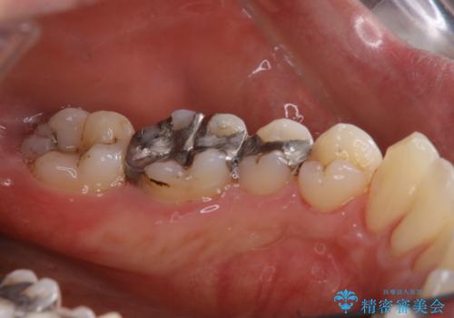 銀歯をセラミックに変える前にPMTCで現状の汚れをきれいに除去の治療後