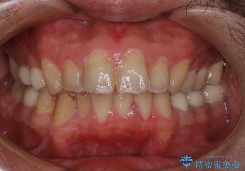 インビザライン矯正治療のスキャニング前のPMTCの治療前