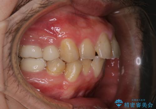 インビザライン矯正治療のスキャニング前のPMTCの治療前