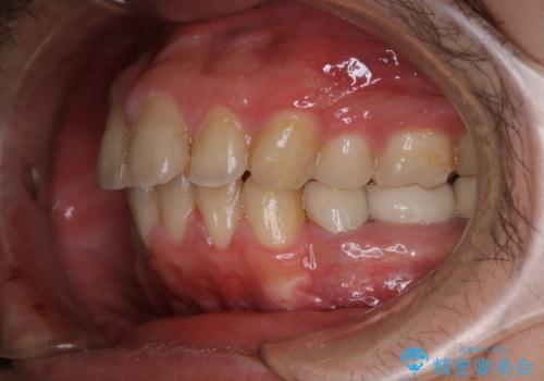 インビザライン矯正治療のスキャニング前のPMTCの治療前